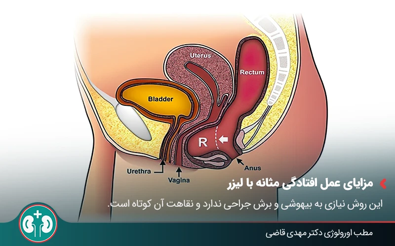 bladder prolapse laser therapy 04