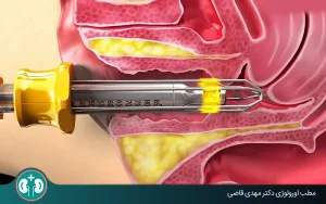 bladder prolapse laser therapy