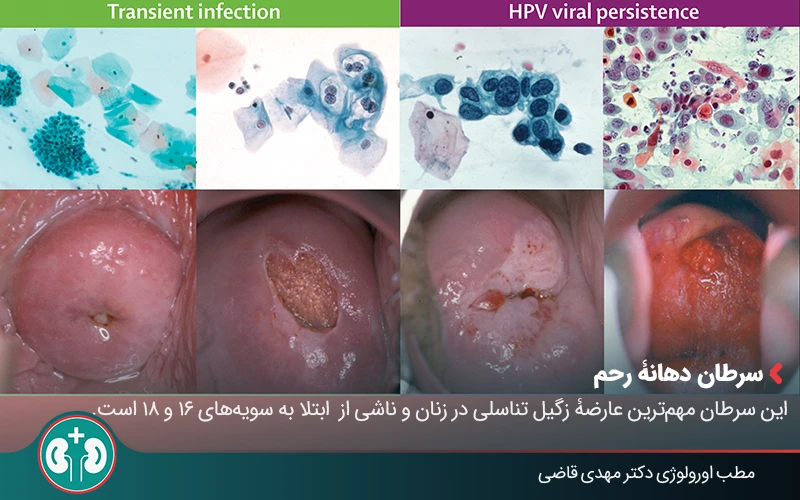 genital warts complications women 04