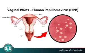 genital warts complications women