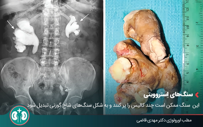 kidney stone complications 03