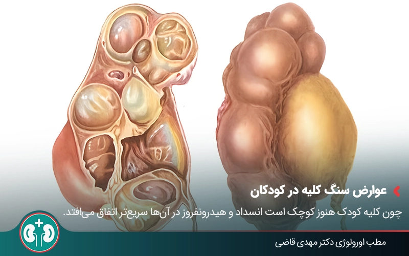 kidney stone complications 04