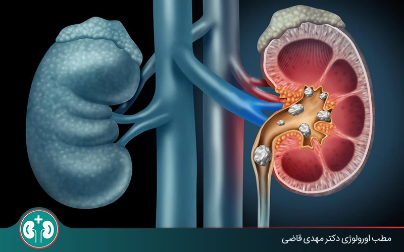 kidney stone complications