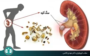 kidney stone in urinary tract