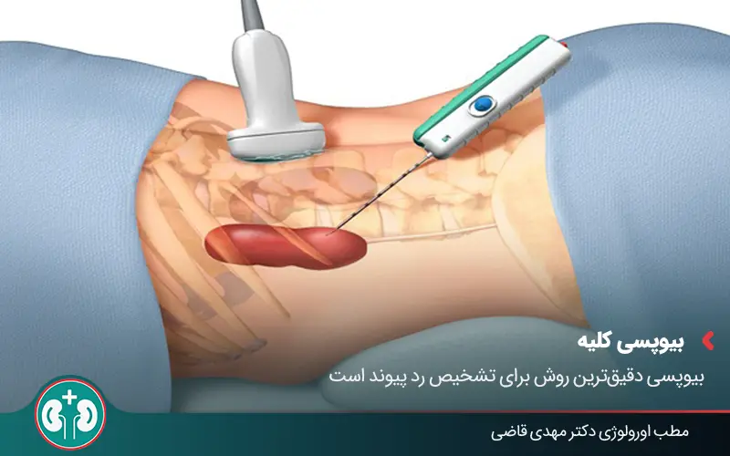 kidney transplant rejection symptoms 04
