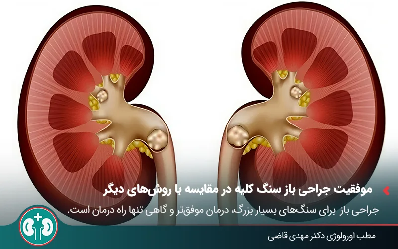 open kidney stone surgery 1