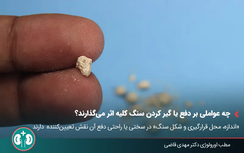 passing 4 10mm kidney stones 02