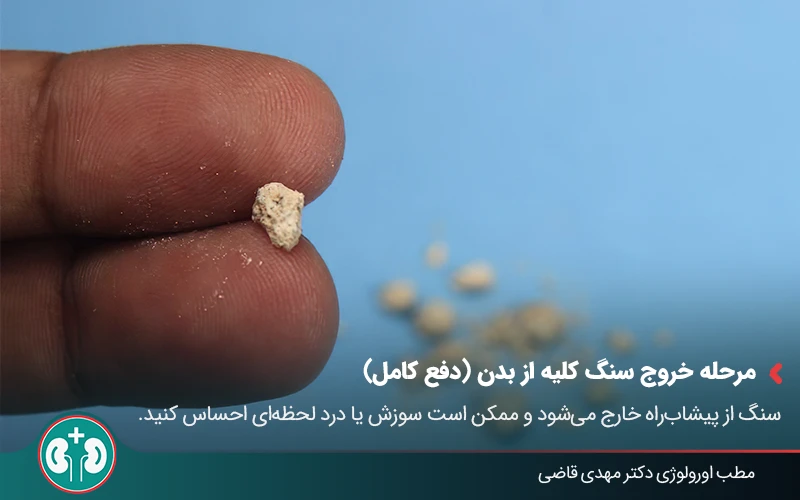 passing kidney stone symptoms 03