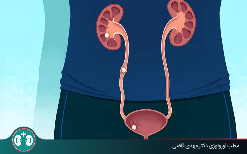 passing kidney stone symptoms