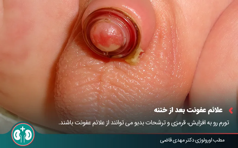 post circumcision infection 01