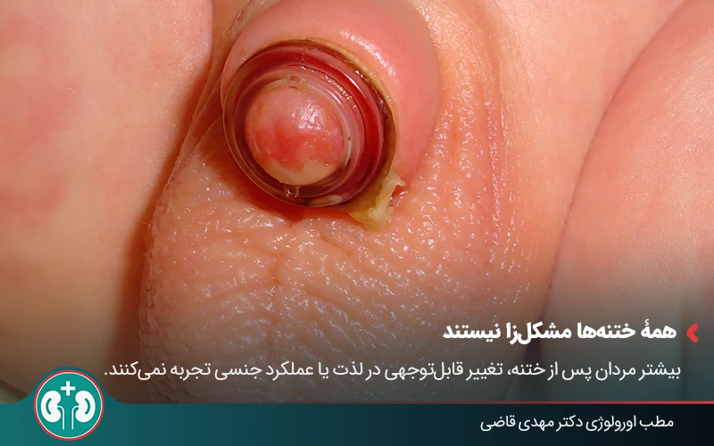 premature ejaculation improper circumcision 01