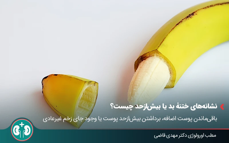 premature ejaculation improper circumcision 02 1