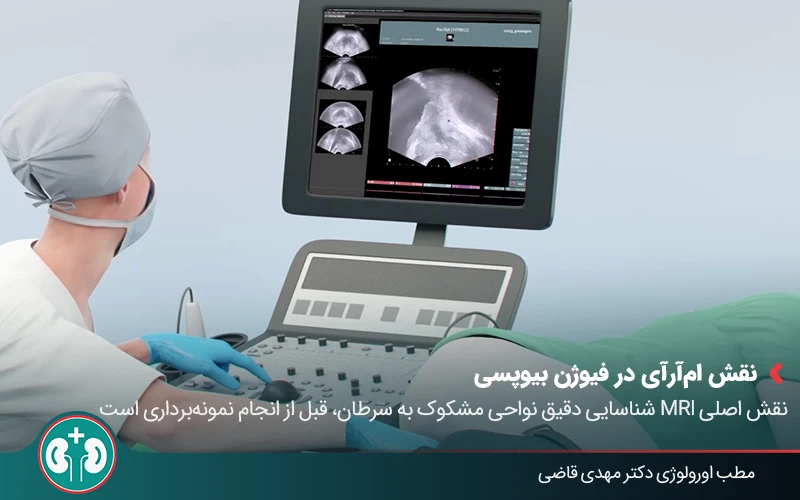 prostate fusion biopsy 01