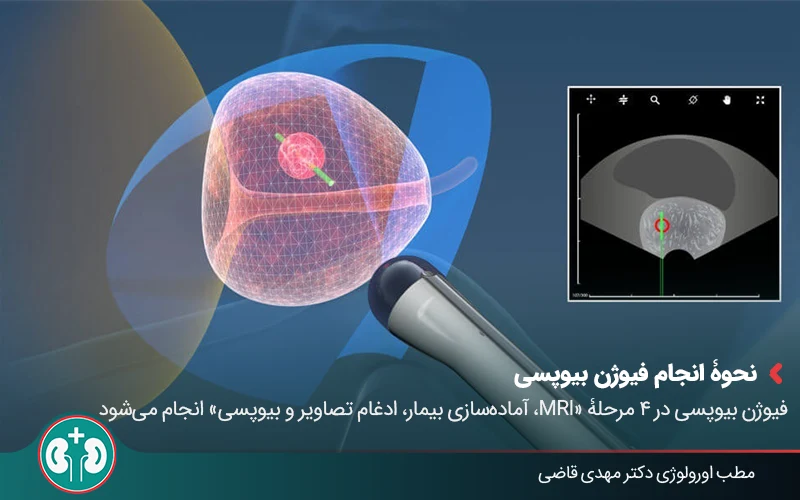 prostate fusion biopsy 03