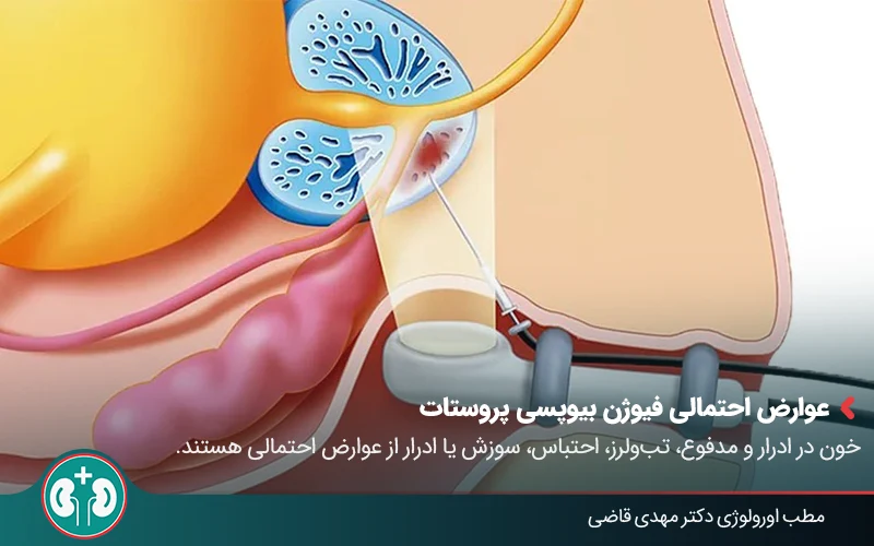 prostate fusion biopsy 04