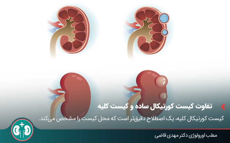 renal cortical cyst 01