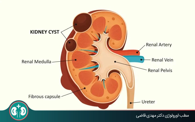 renal cortical cyst