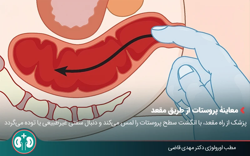 Prostate cancer screening 03