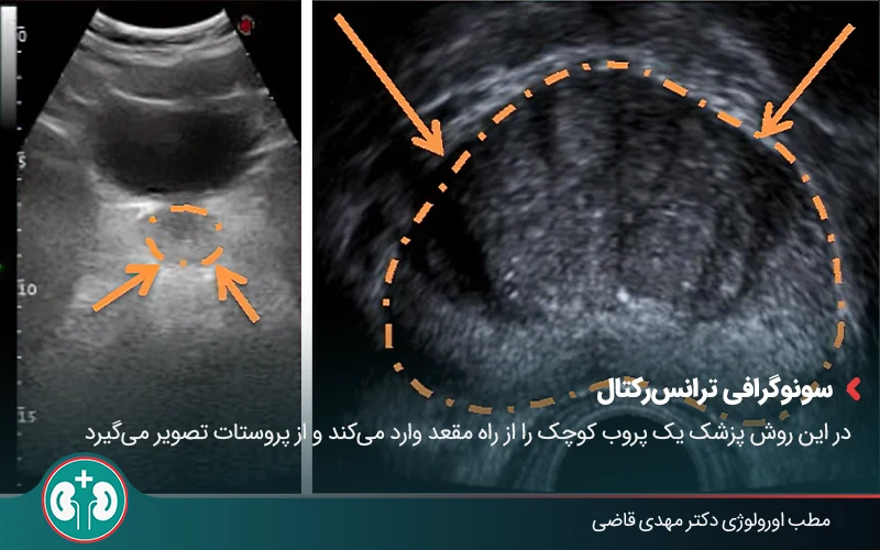 Prostate cancer screening 04