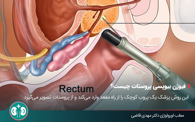 Prostate cancer screening 5