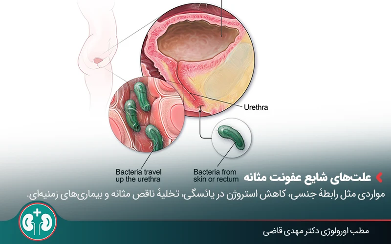 تصویر پزشکی که نشان می‌دهد چگونه باکتری‌ها وارد مجرای ادرار می‌شوند.