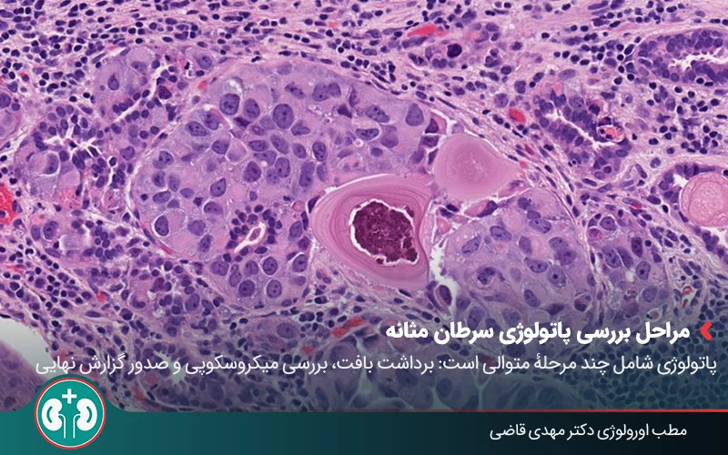 bladder cancer pathology 02