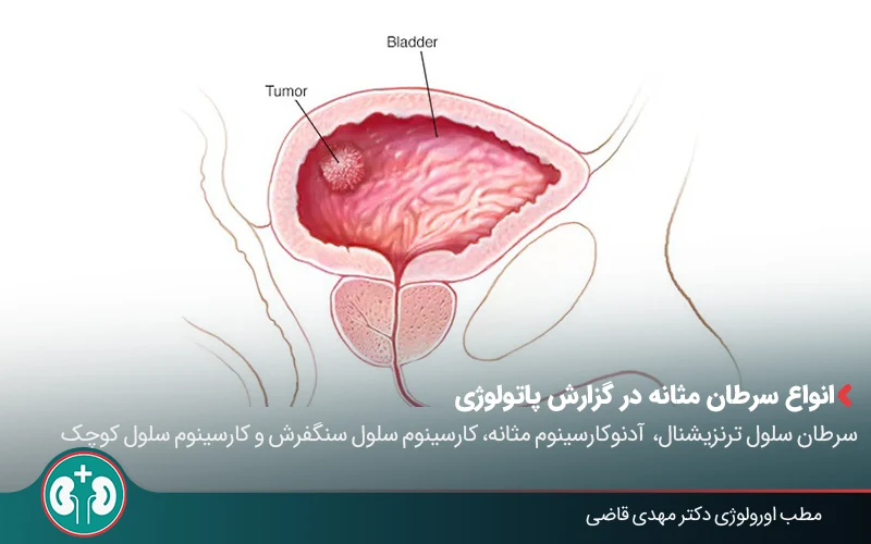 bladder cancer pathology 03