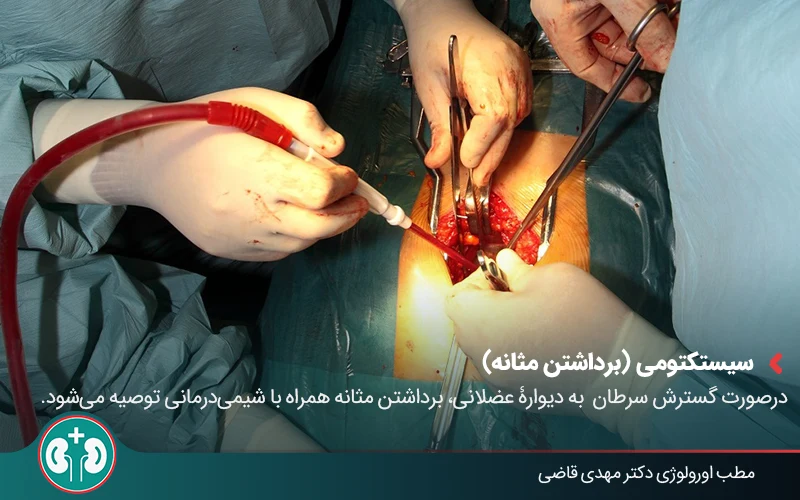 bladder cancer pathology 04