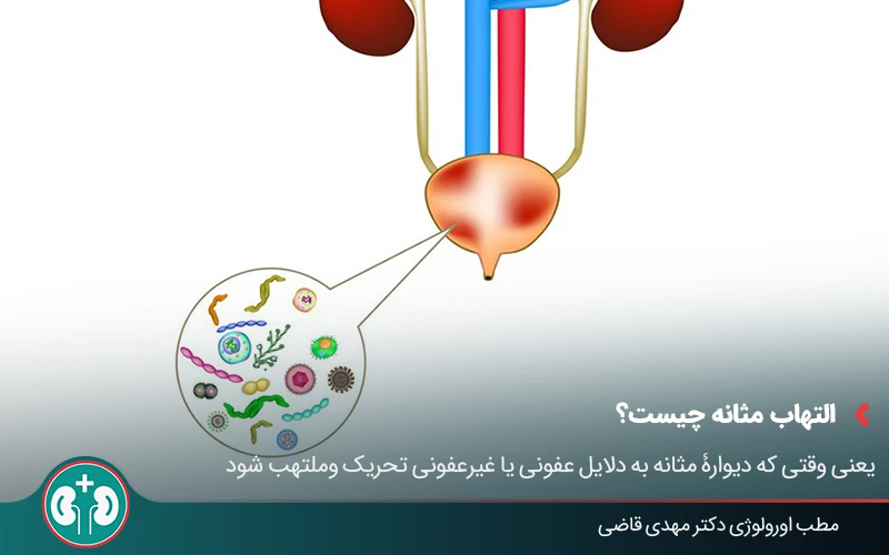 cystits treatment 01