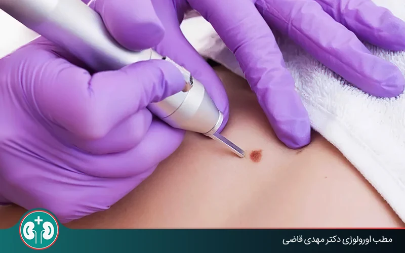 genital warts laser therapy