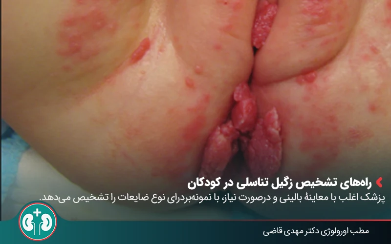 genital warts symptoms in children 03