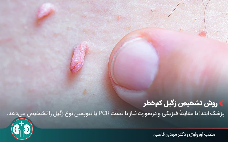 low risk genital warts symptoms 02