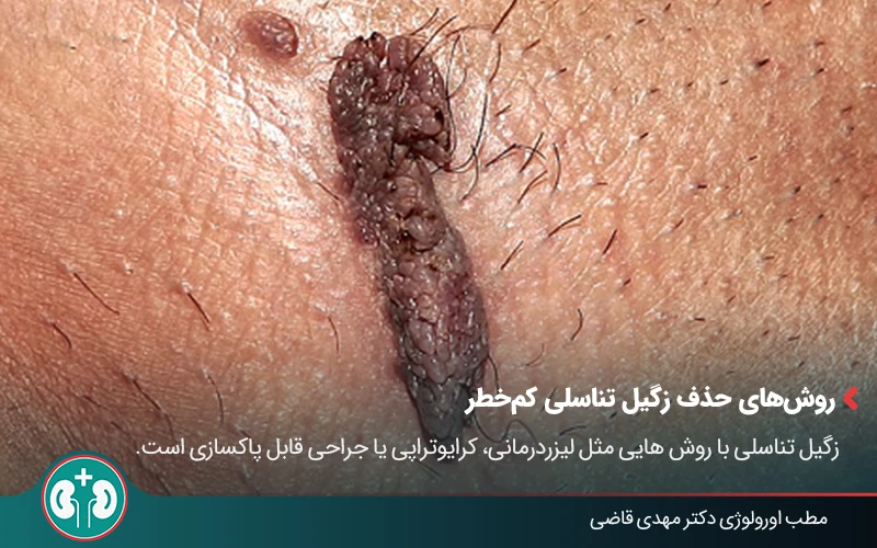 low risk genital warts symptoms 04