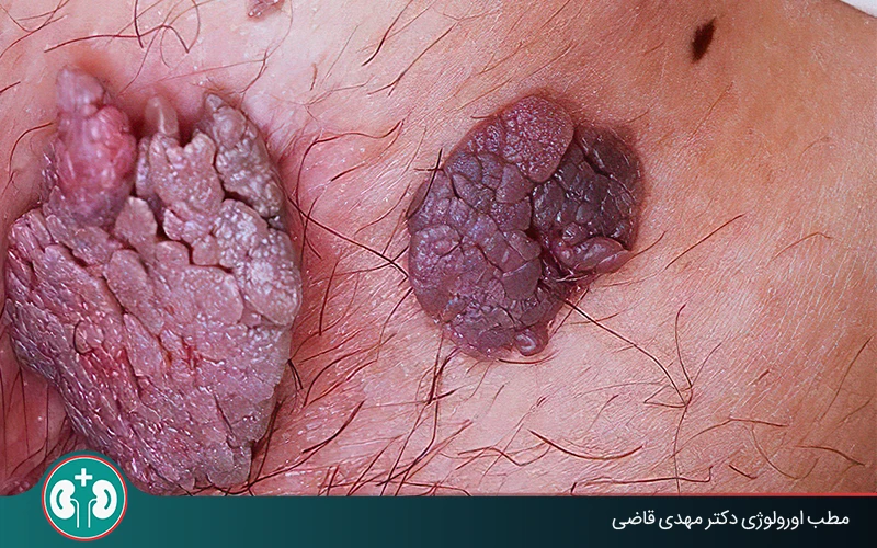 low risk genital warts symptoms