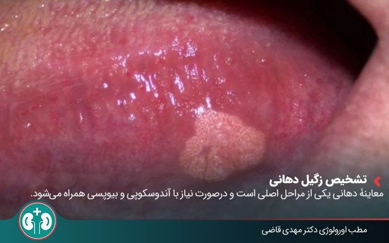 oral genial warts symtoms 03