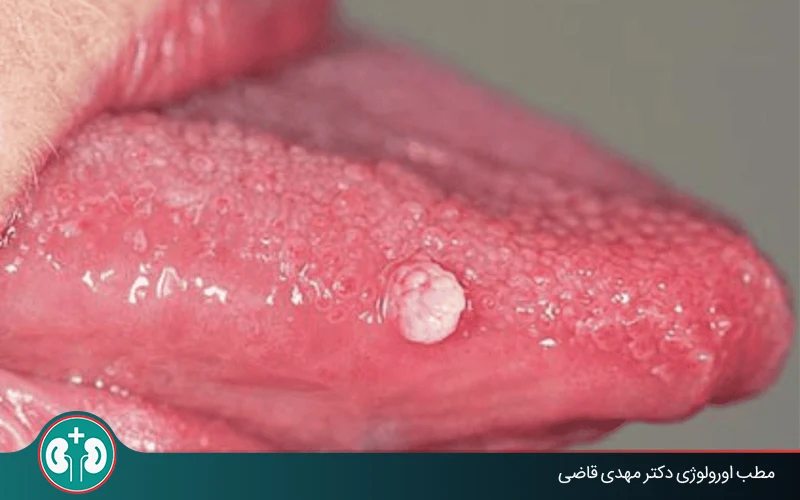 oral genial warts symtoms