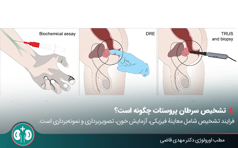 prostate cancer diagnosis 01