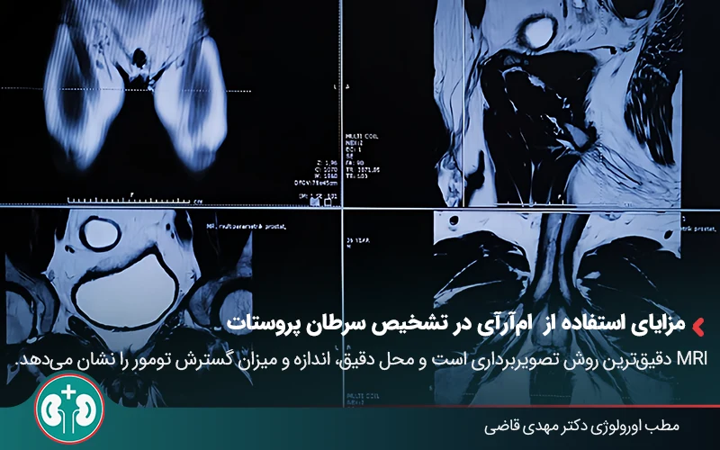 prostate cancer diagnosis 03