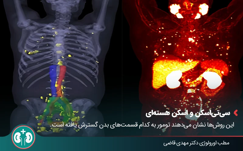 prostate cancer diagnosis 04
