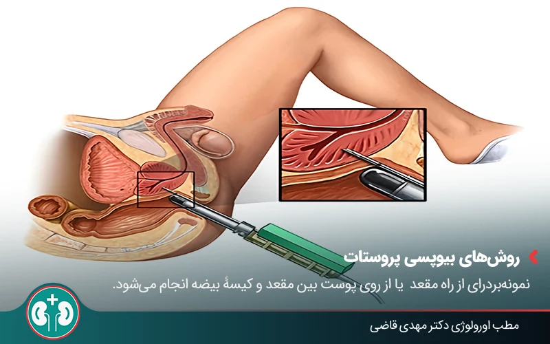 prostate cancer diagnosis 05