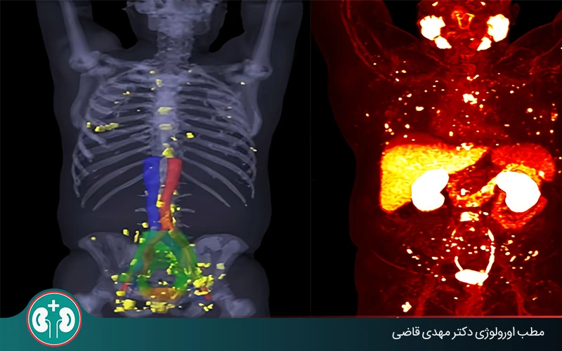 prostate cancer metastasize to bone