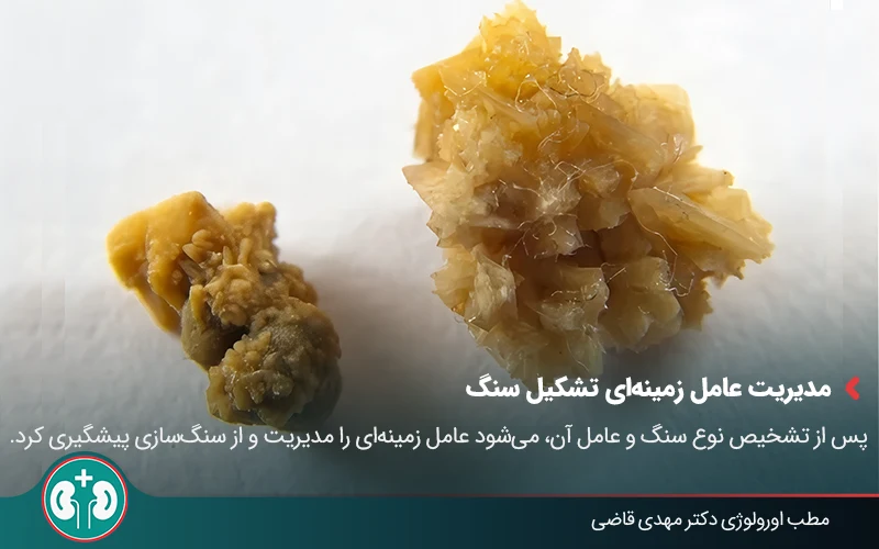 types of kidney stones 01