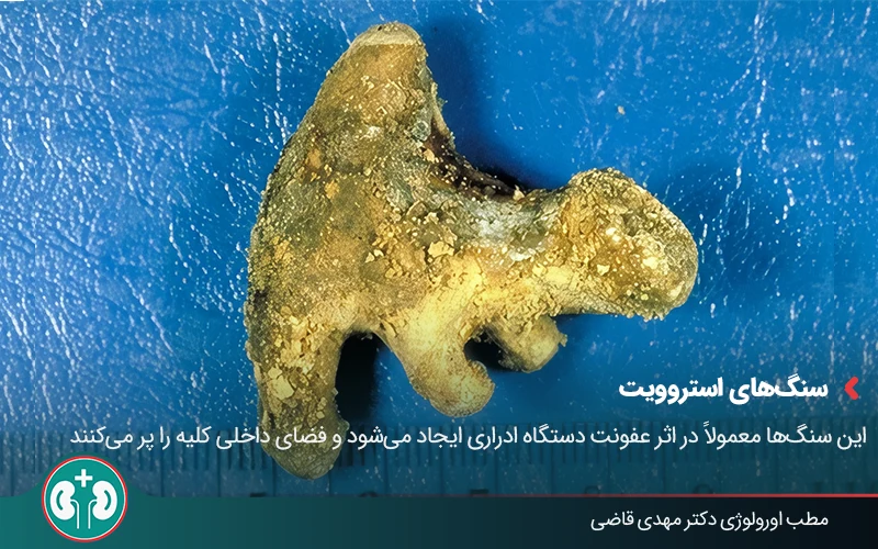 types of kidney stones 02