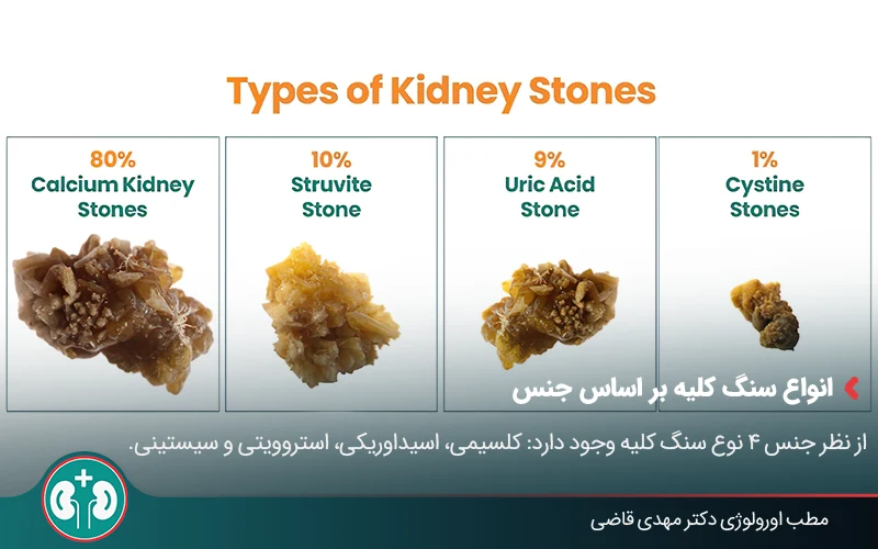types of kidney stones 03