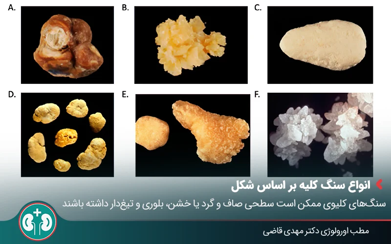 types of kidney stones 04