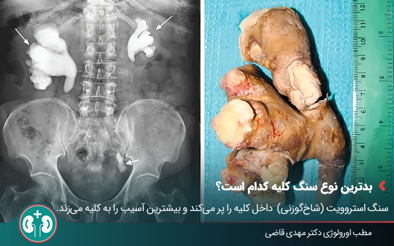 types of kidney stones 06