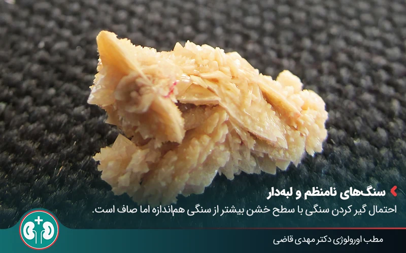 types of kidney stones 08