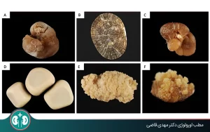 types of kidney stones