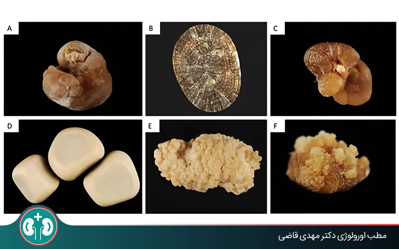 types of kidney stones