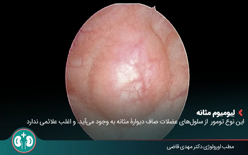 Benign Bladder Tumor 02